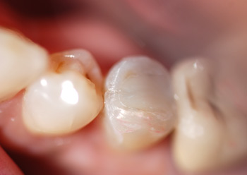 after resin composite restoration