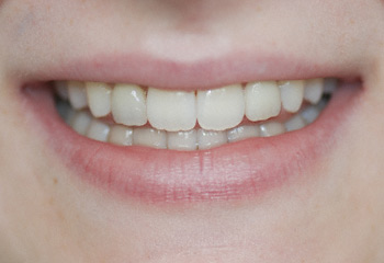 after veneers