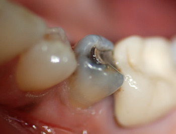silver amalgam before new restoration