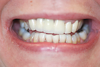 after crown & bridge/bleaching