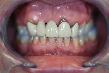 before crown & bridge