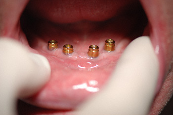 before lower denture insertion