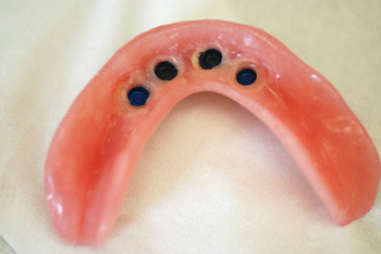 underside of denture