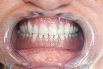 after denture insertion