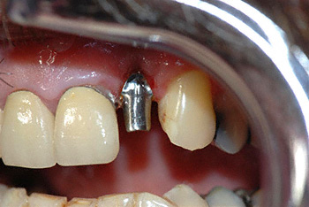 before implant example 2