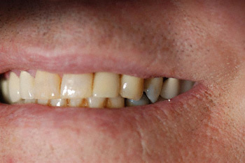 after implant example 3