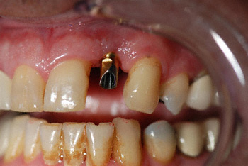 before implant example 3