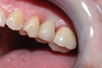 after implant example 4