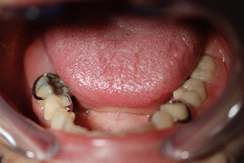 after partial denture