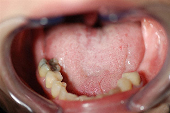 before partial denture